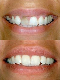 dental before and after 2